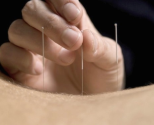 Study shows acupuncture effective for chronic pain